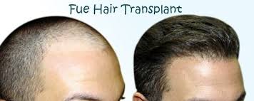 How Costly Is Hair Transplant Quora how costly is hair transplant quora