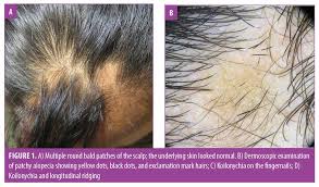 Check spelling or type a new query. Koilonychia In A Patient With Alopecia Areata Jcad The Journal Of Clinical And Aesthetic Dermatology