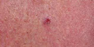 Merkel cell carcinoma was previously believed to arise from merkel cells , which are pressure receptors in the skin. Merkle Cell Carcinoma Skin Cancer And Reconstructive Surgery Center