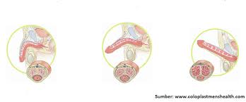 Lo hwa loon, doktor pakar urology dari hospital kuala lumpur (hkl). Apa Itu Mati Pucuk Erectile Dysfunction Suami Tolonglah Ambil Tahu