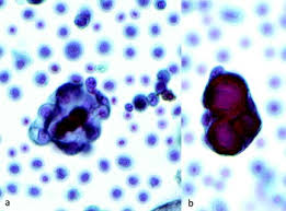 Lymphoma, melanoma and mesothelioma may also present initially as a malignant pleural effusion of unknown primary. Cytology Of Pleural And Peritoneal Lesions Chapter 5 Practical Pathology Of Serous Membranes