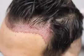 Un homme portera plus son choix sur une tondeuse à barbe pour se raser ou délimiter les contours la tondeuse à cheveux professionnelle s'utilisera davantage pour s'offrir une nouvelle tête et changer. Greffe De Cheveux En Turquie Ce Qu Il Faut Savoir Avant L Implant