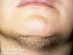 Every woman has facial hair, there is nothing to be ashamed about. Laser Hair Removal Before After Photos Facial Hair Female Chin