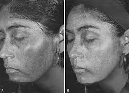 DISORDERS OF HYPERPIGMENTATION