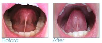 Image result for Ankyloglossia