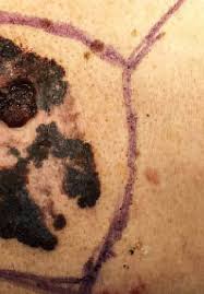 Lymph nodes are an … Cutaneous Metastases From Malignant Melanoma Clinical Features And New Therapeutic Perspectives Intechopen