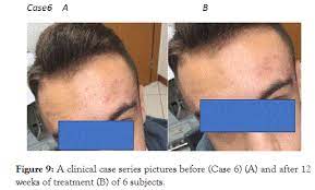 Efficacy And Tolerability Of A Tretinoin 0 02 Clindamycin 0 8 And Glycolic Acid 4 Gel In Acne A Multicenter Prospective Pragmatic Assessor Blinded 12 Week Trial On 159 Subjects