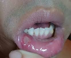 Image result for mouth ulcer on tongue)