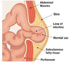 Image result for Hernia Reduction