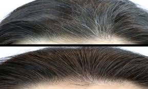 Pin By Lre On Egeszseg Remove Gray Hair White Hair Hair Health