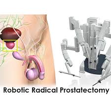 Image result for Radical Prostatectomy