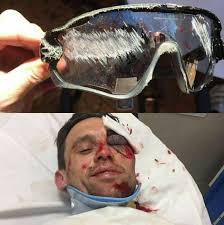 Os oculos originais da OakleyBrasil salvaram a visão deste ciclista!  Imagine o que seria dele se estivesse usando um produto falsificado?  Poderia ter se machucado ainda mais! Use sempre produtos originais e