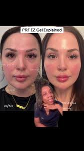 Prf Ez Gel Smile Lines Before and After