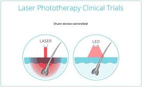 This means you can share the device with your spouse if you like. Led Vs Lasers For Hair Growth Treatments Which Is Better