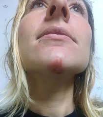 Poison Ivy and Oak Rash Pictures