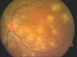 Apmppe abbreviation stands for acute posterior multifocal placoid pigment epitheliopathy. Jaypeedigital Ebook Reader