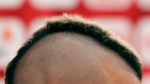 A treatment with hair stem cells is very beneficial to regenerate hair and stimulate its growth; A Cure For Baldness Could Be Around The Corner The Atlantic