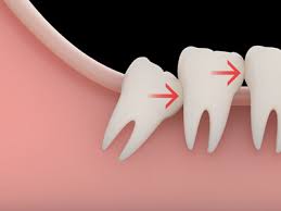 Fortunately, there are ways to prepare yourself that will make it easier to tolerate what's to come. The 48 Hours After Your Wisdom Teeth Have Been Removed Ironhorse Family Cosmetic Dentistry Leawood Kansas