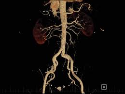 Image result for CT Intravenous Contrast