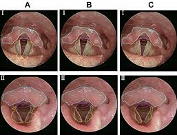 Image result for Reflux Laryngitis