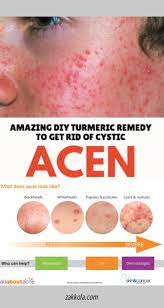 Read About Acne Please Click Here To Read More Best Acne Remedies Acne Acne Remedies