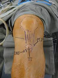 Endoscopic Management Of Osgood Schlatter Disease Arthroscopy Techniques