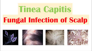 When you get a fungal infection on your scalp, the body responds by sending immune cells to the site. Fungal Infection Of The Scalp Tinea Capitis Causes Risk Factors Symptoms Diagnosis Treatment Youtube