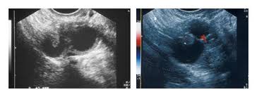 Dr mohammad osama hussein yonso ◉ and dr david carroll ◉ et al. Early Detection Of Ovarian Cancer With Conventional And Contrast Enhanced Transvaginal Sonography Recent Advances And Potential Improvements
