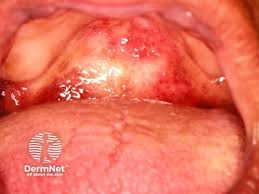 Image result for Oral herpes roof of mouth
