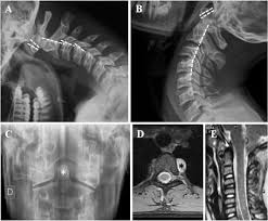 Radiologic Findings Related To Headache In Jhs Eds Ht Latero Lateral Download Scientific Diagram