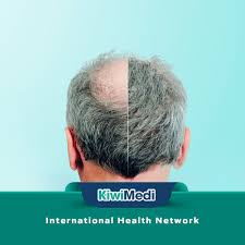 Capilclinic is located across the world notably in the uk and istanbul. Best Hair Transplant Clinic In Turkey Best Hair Transplant Cool Hairstyles Hair Transplant