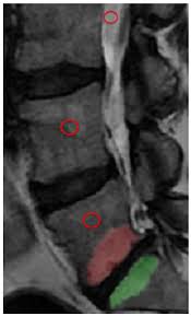 Image result for Low Back Imaging