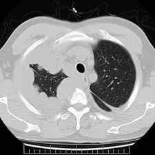 Improving the accuracy of staging can refine patient selection. Pleural Mesothelioma Eurorad