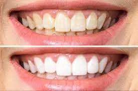 There's also the option to maintain your whiter smile with a philips zoom! Teeth Whitening Professional Tooth Whitening Centerburg Ohio