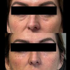 When I flew to LA to train with the inventor of the Non Surgical Nose Job,  I quickly learned how many people are ultimately unsatisfied with their  surgical rhinoplasty results The NSNJ