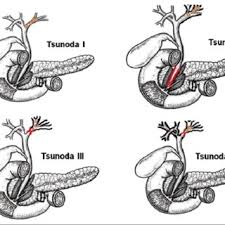 The pnghost database contains over 22 million free to download transparent png images. Clasificacion Endoscopica De La Hepatolitiasis Segun Tsunoda Tomado De Download Scientific Diagram