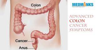 Having advanced cancer can bring anxiety and uncertainty to your life. What Are Advanced Colon Cancer Symptoms Medmonks