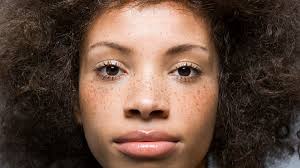 Image result for Freckled skin