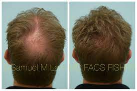 This Gentleman Is Shown Before And After Slmax Hair Building Fibers Roots Hair Hair Fibers Dallas Hair