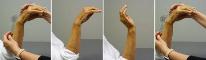 Image result for Scaphoid Shift Test