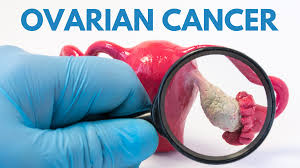 Find clinical trials for ovarian cancer. Ovarian Cancer Why Early Diagnosis Is So Important Intrust Care