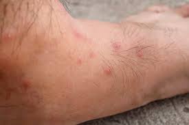 Image result for Fire Ant Sting