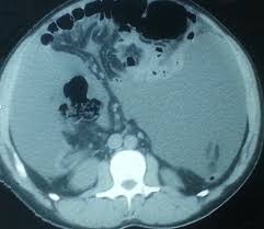 The purpose of this study is to report the. Cureus A Case Of Well Differentiated Papillary Mesothelioma Of The Male Peritoneum Successful Treatment By Systemic Chemotherapy