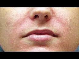 как избавиться от белых пятен на лице в домашних условиях Omolazhivayushaya Maska Dlya Ochen Suhoj Dryabloj Morshinistoj Kozhi Youtube Maski Lico Kozha