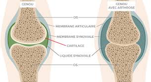 Inhalt was ist arthrose und wie entsteht die krankheit wie entstehen schäden am gelenk? Les Problemes D Arthrose Causes Et Traitements