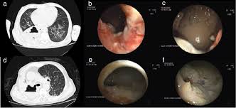 Image result for Lung Abscess