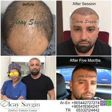 Photo Of Zain Hair Esthetic Center Istanbul Turkey Hair Transplant Hair Transplant Turkey Olcay Saygin Euro Zen Hair Best Doctor In Turkey Hair Transpl