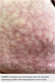 Pdf Erythema Ab Igne A Mottled Rash On The Torso Semantic Scholar