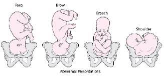 One hour after the randomisation, 35 of 203 (17%) fetuses were diagnosed as being in the occiput anterior position in the intervention group compared with 24 of 209 (12%) in the control group. Abnormal Position And Presentation Of The Fetus Women S Health Issues Merck Manuals Consumer Version