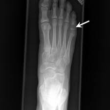 Ballet dancers may develop sesamoiditis. X Ray Of The Right Foot Case No 1 Showing A Radiolucent Lesion Of Download Scientific Diagram